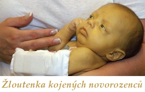 ikterus zloutenka kojenych novorozencu priznaky projevy symptomy pricina lecba