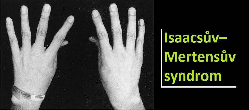 isaacsuv-mertensuv-syndrom-neuromyotonie-priznaky-projevy-symptomy