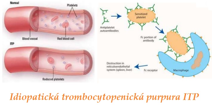 itp idiopaticka trombocytopenicka purpura imunitni trombocytopenie priznaky projevy symptomy