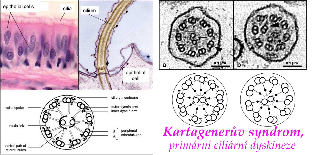 kartageneruv syndrom primarni ciliarni dyskineze priznaky projevy symptomy