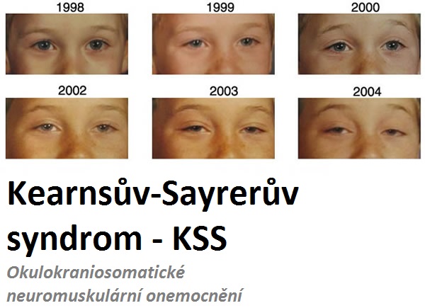 kearnsuv-sayreruv-syndrom-kss-okulokraniosomaticke-neuromuskularni-onemocneni-priznaky-projevy