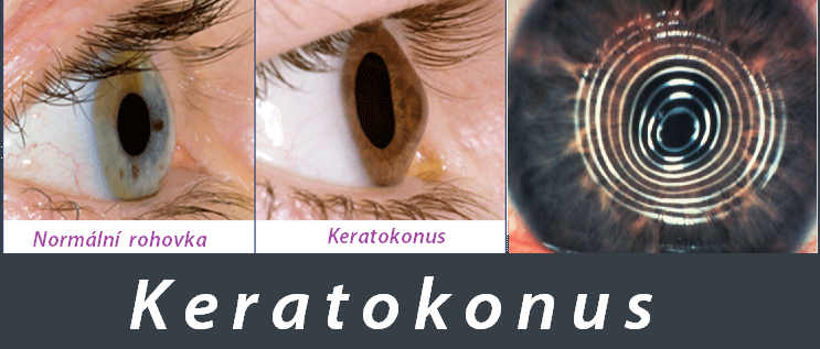 keratokonus-priznaky-projevy-symptomy