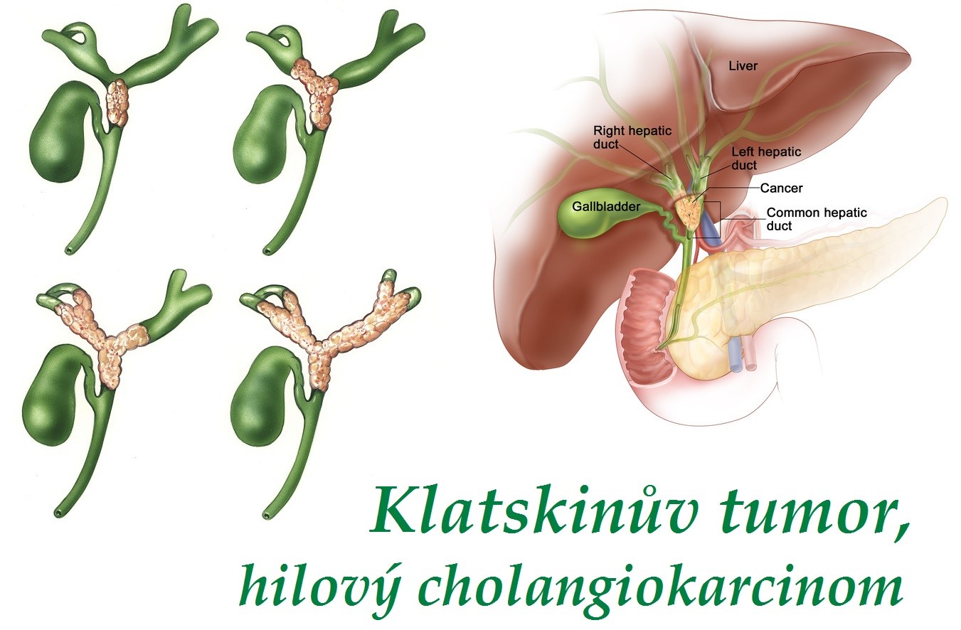 klatskinuv-tumor-hilovy-cholangiokarcinom-priznaky-projevy-symptomy