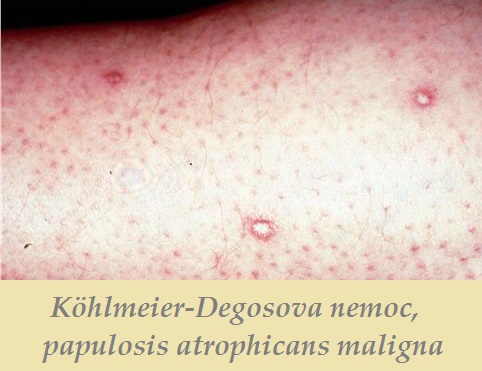 kohlmeier-degosova-nemoc-papulosis-atrophicans-maligna-priznaky-projevy-symptomy