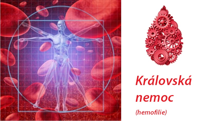 kralovska-nemoc-hemofilie-priznaky-projevy-symptomy