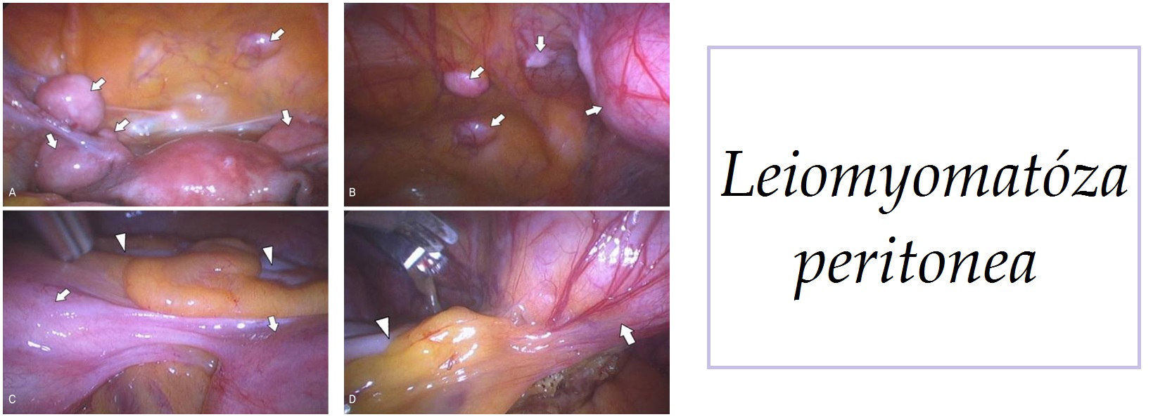 leiomyomatoza peritonea priznaky projevy symptomy pricina lecba
