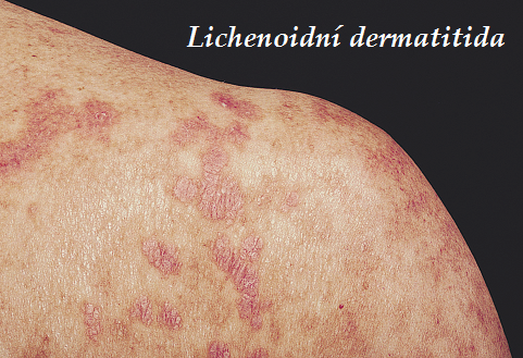 lichenoidni dermatitida priznaky projevy symptomy pricina lecba