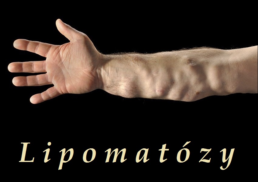 lipomatozy-dercumova-choroba-madelungova-choroba-ad-lipomatozy-priznaky-projevy