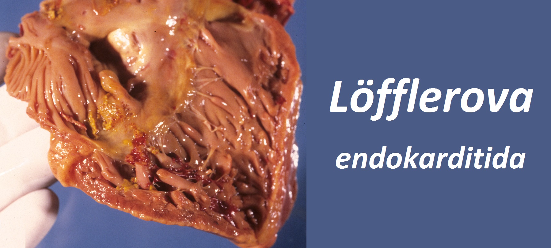 Löfflerova endokarditida příznaky projevy symptomy příčina léčba fotografie obrázek