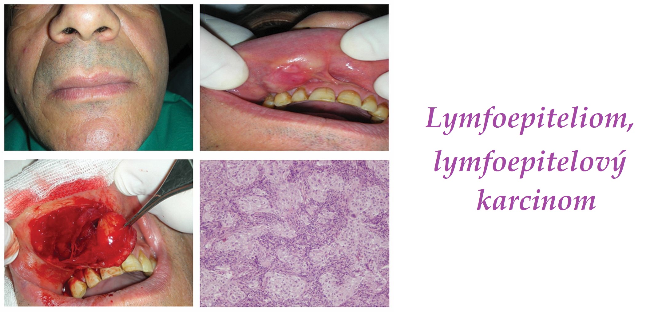lymfoepiteliom lymfoepitelovy karcinom priznaky projevy symptomy pricina lecba