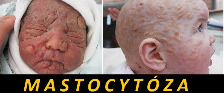 mastocytoza-priznaky-projevy-symptomy