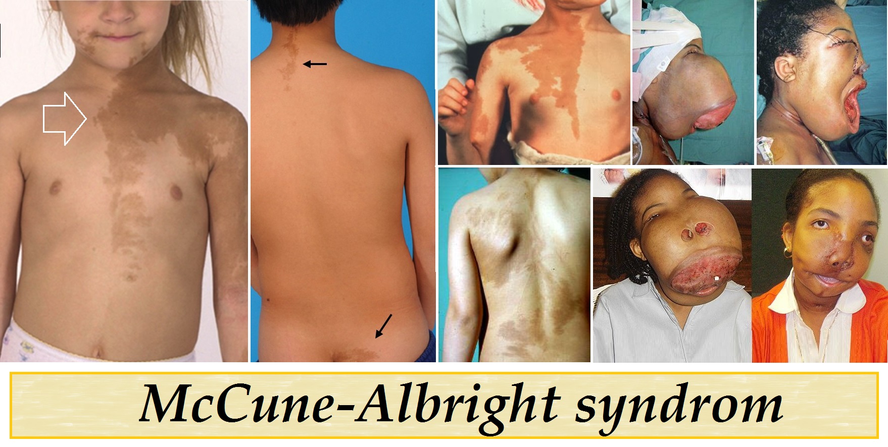 mccune-albright-syndrom-priznaky-projevy-symptomy