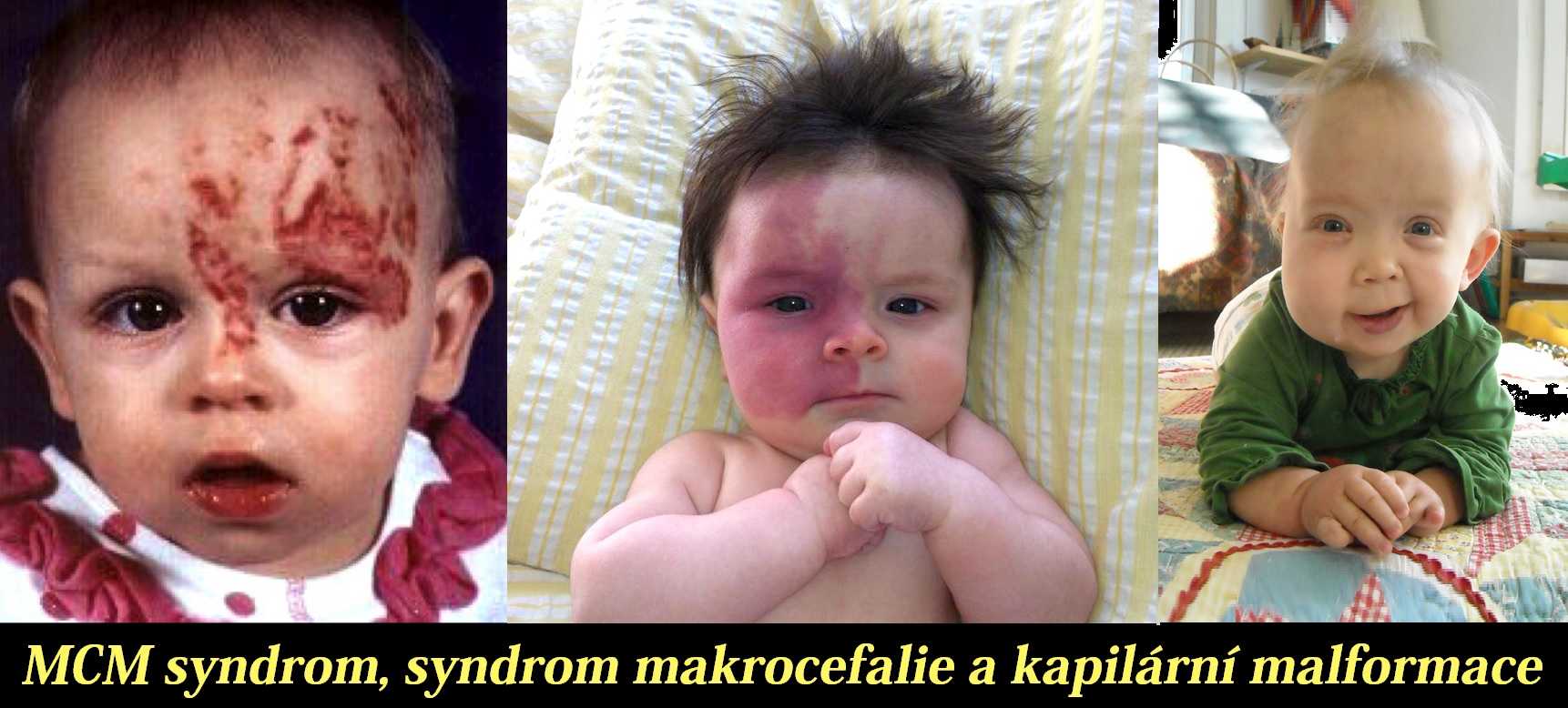 mcm-syndrom-syndrom-makrocefalie-a-kapilarni-malformace-priznaky-projevy-symptomy