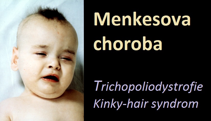 menkesova-choroba-trichopoliodystrofie-kinky-hair-syndrom-priznaky-projevy-symptomy