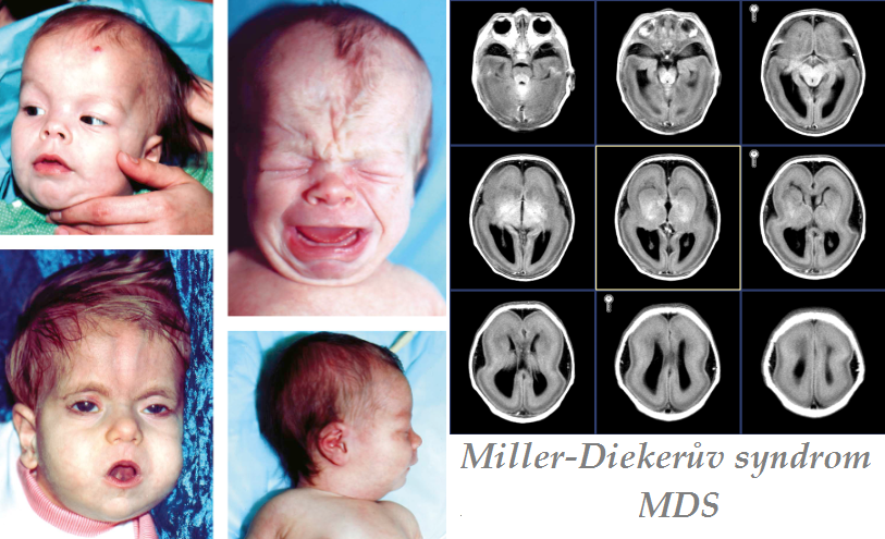 miller diekeruv syndrom MDS priznaky projevy symptomy