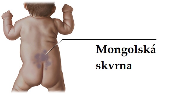 mongolska-skvrna-priznaky-projevy-symptomy