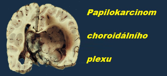 nador-karcinom-choroialniho-plexu-mozku-priznaky-projevy-symptomy