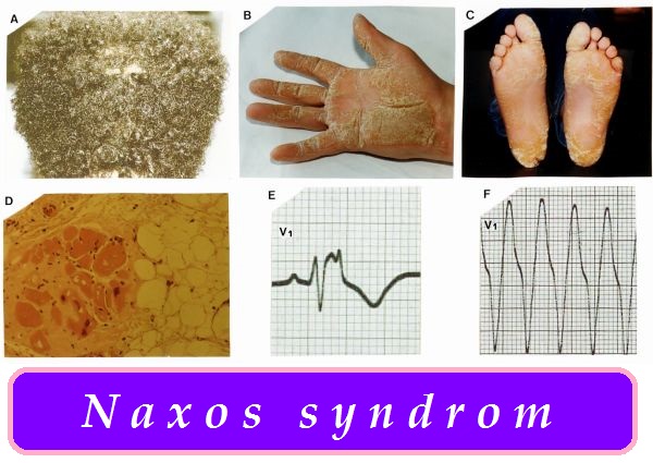 naxos syndrom kardiokutanni syndrom priznaky projevy symptomy pricina lecba