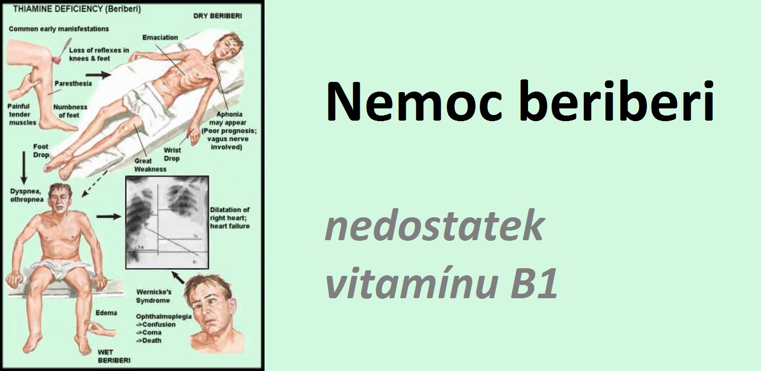 nemoc-beri-beri-nedostatek-B1-thiaminu-priznaky-projevy-symptomy