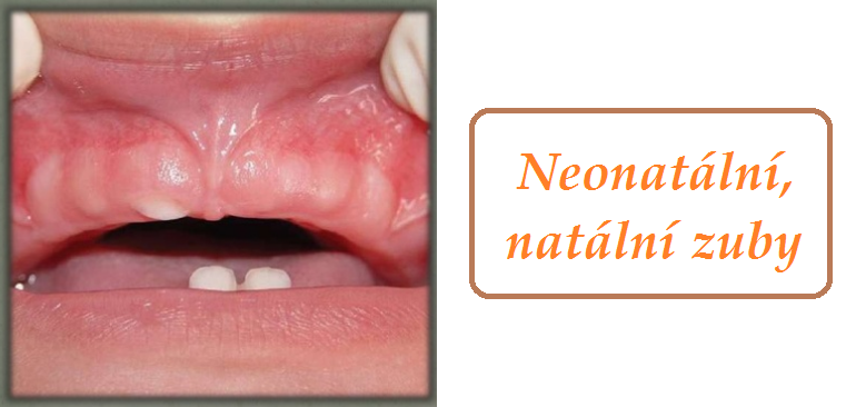 neonatalni zuby natalni zuby priznaky projevy symptomy pricina lecba fotografie obrazek