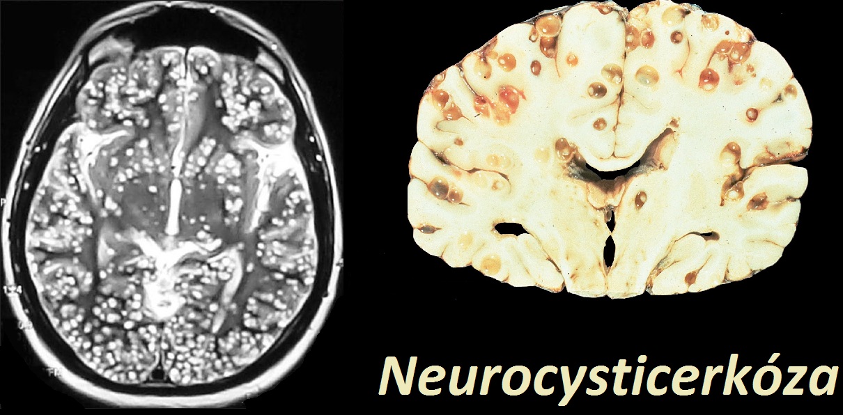 neurocysticerkoza-priznaky-projevy-symptomy