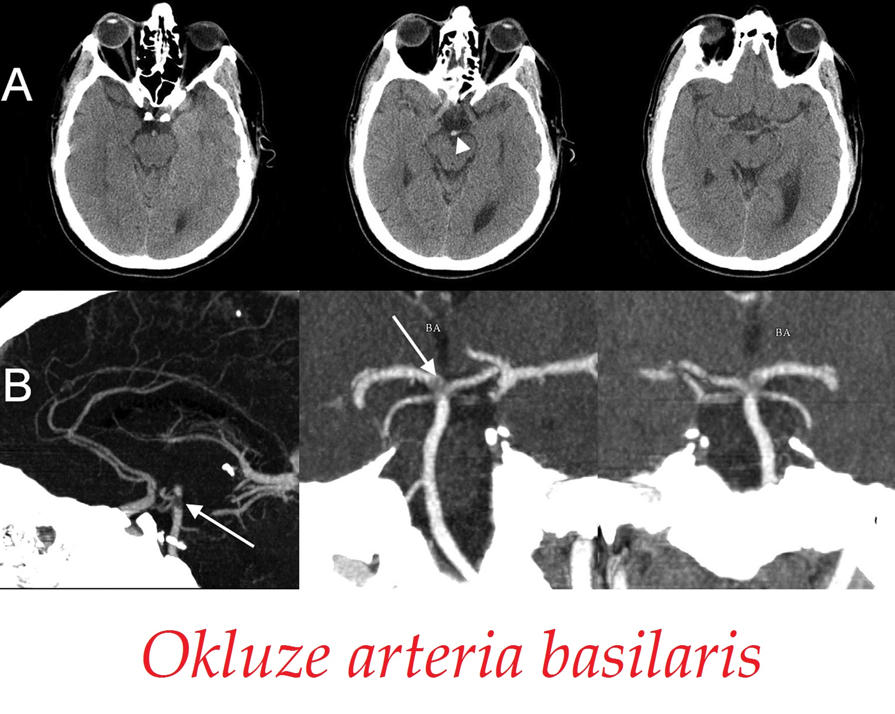okluze arteria basilaris okluze bazilarni tepny priznaky projevy symptomy