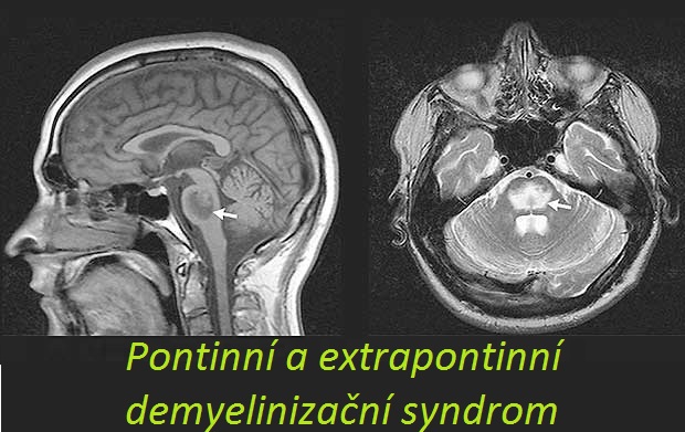 osmoticky demyelinizacni syndrom centralni pontinni extrapontinni myelinolyza priznaky projevy symptomy pricina lecba