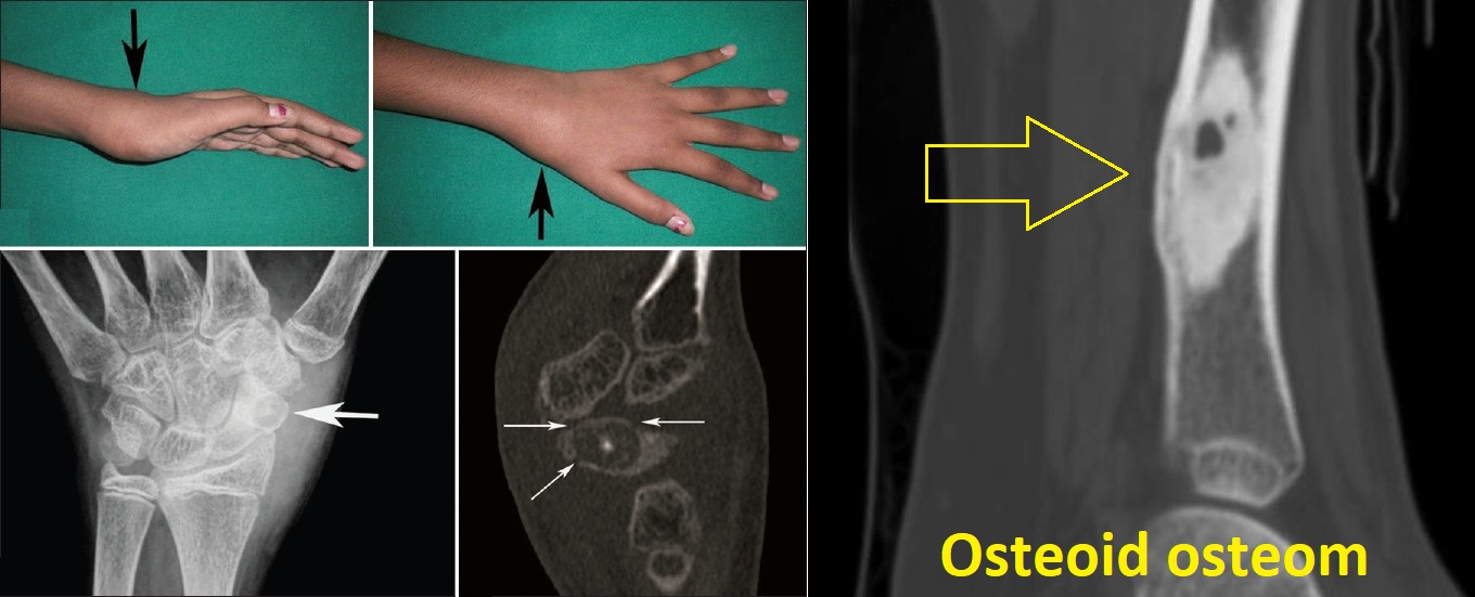 osteoid osteom priznaky projevy symptomy pricina lecba aspirinovy test