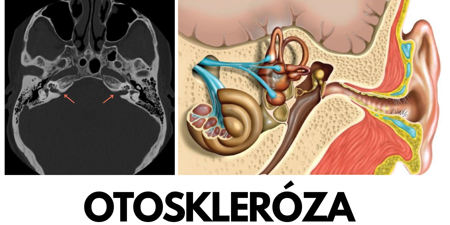 Otoskleróza příznaky projevy symptomy příčina léčba diagnostika