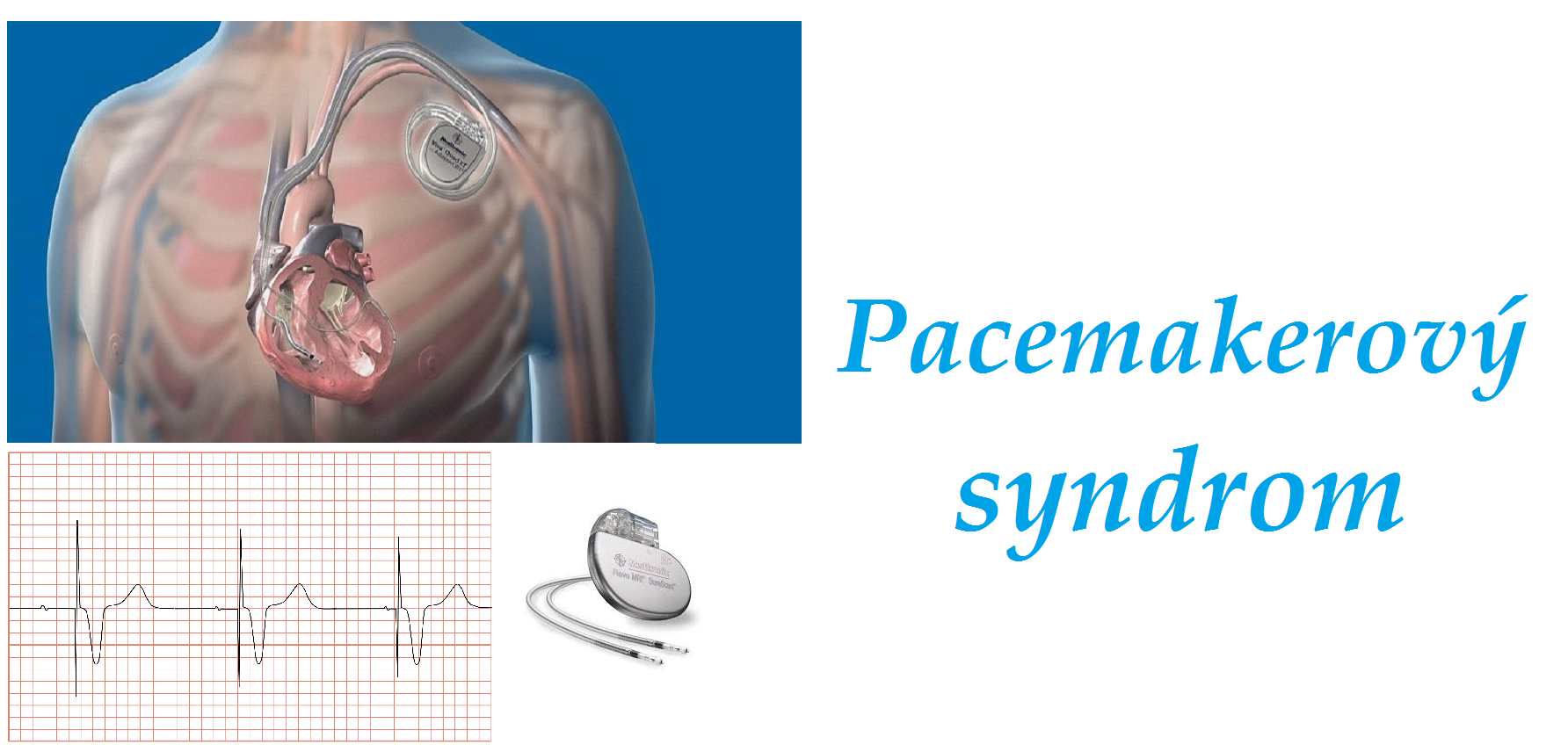 pacemakerovy syndrom priznaky projevy symptomy