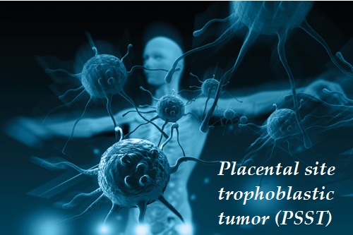 placental site trophoblastic tumor pstt priznaky projevy symptomy