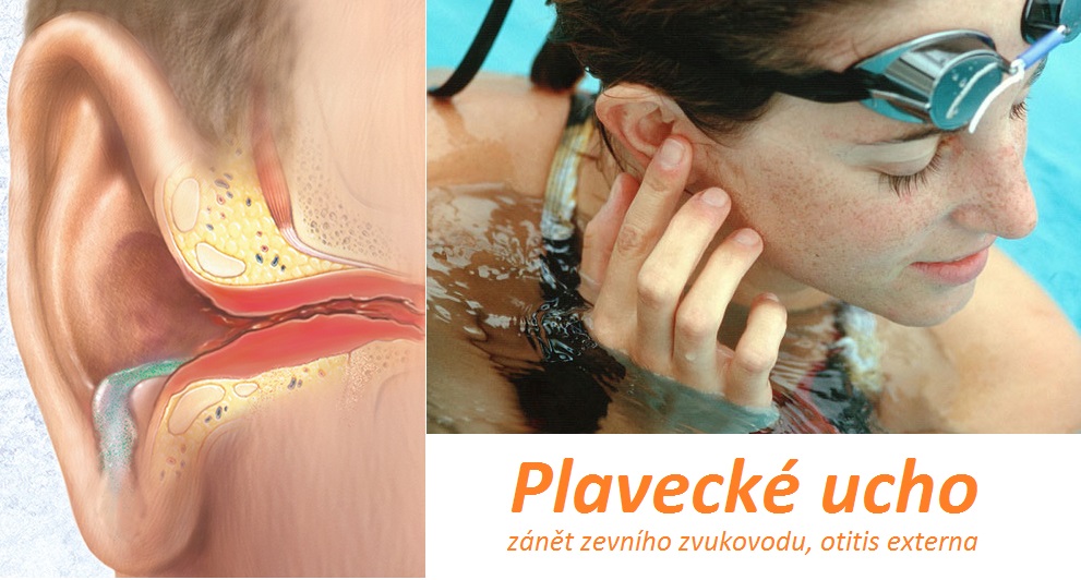 plavecke ucho zanet zvukovodu otitis externa priznaky projevy symptomy pricina lecba