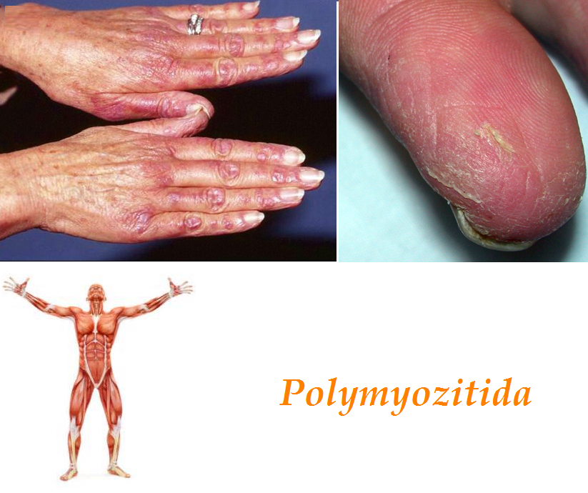 polymyozitida priznaky projevy symptomy