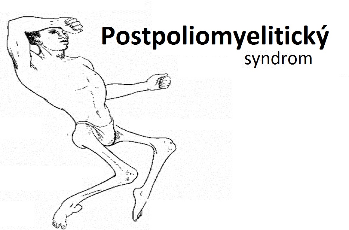 postpoliomyeliticky-syndrom-priznaky-projevy-symptomy
