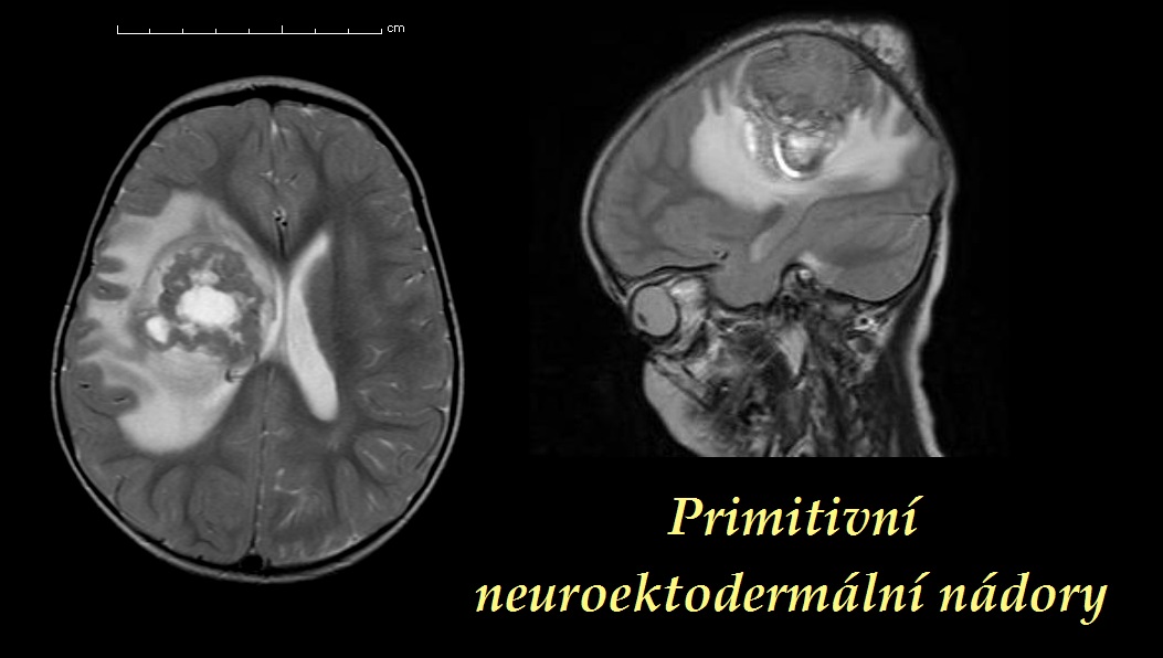 primitivni-neuroektodermalni-nadory-pnet-priznaky-projevy-symptomy