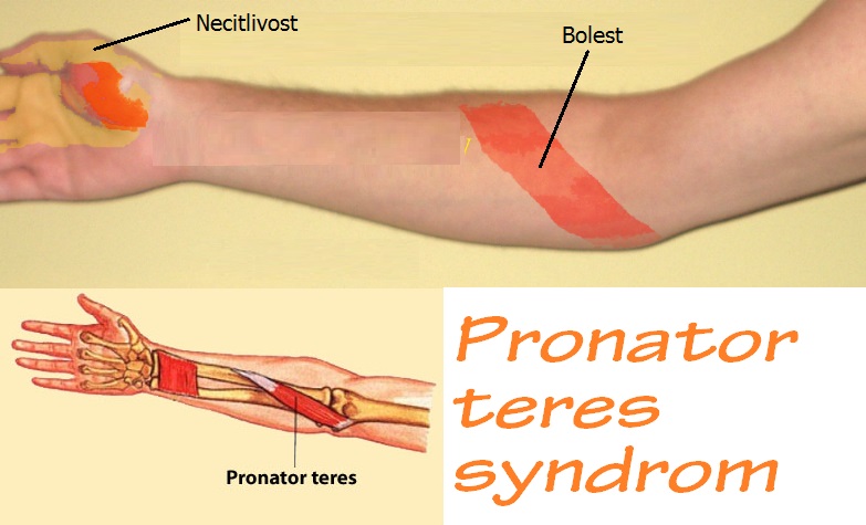 pronator-teres-syndrom-priznaky-projevy-symptomy