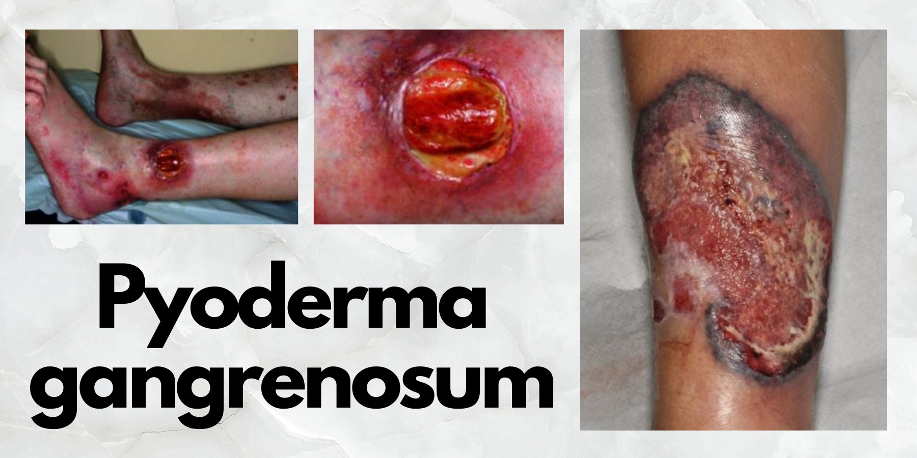 pyoderma gangrenosum priznaky projevy symptomy fotografie obrazek