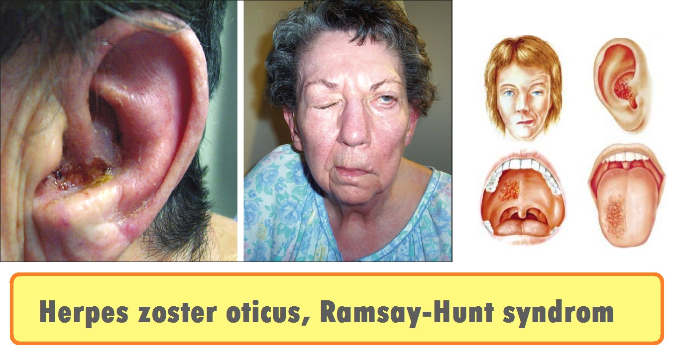 ramsay-hunt-syndrom-herpes-zoster-oticus-priznaky-projevy-symptomy
