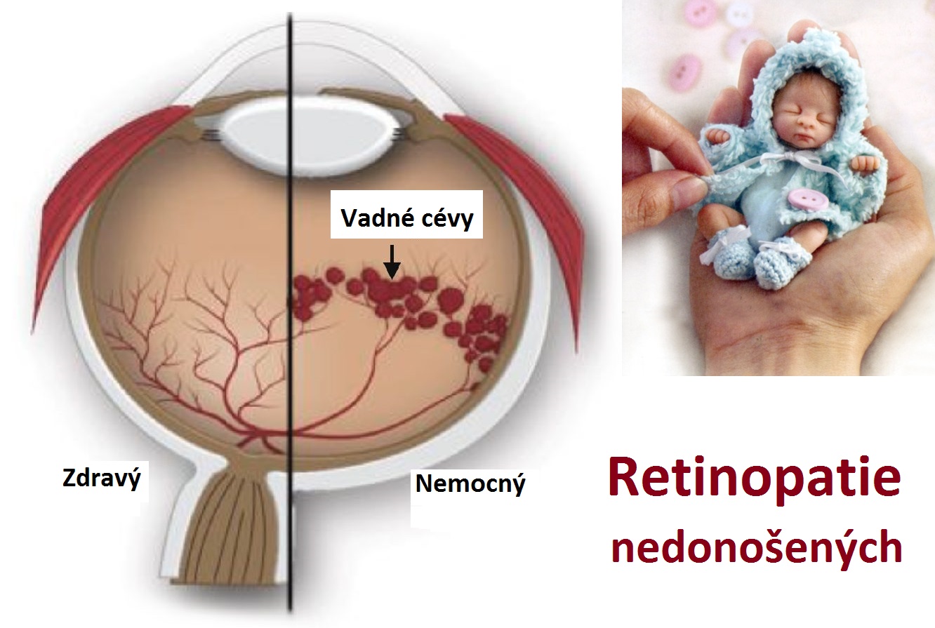 retinopatie nedonosenych priznaky projevy symptomy pricina lecba