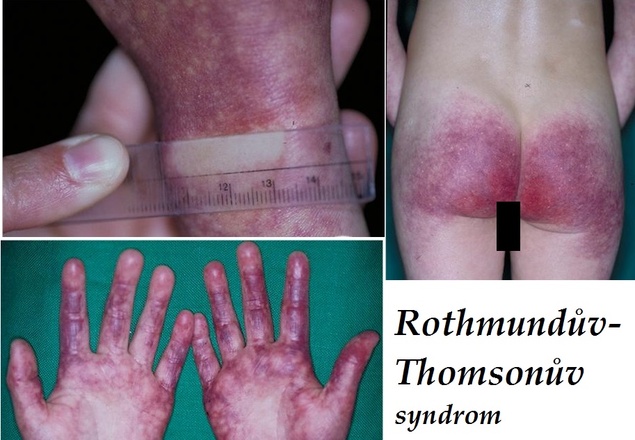 rothmunduv-thomsonuv-syndrom-priznaky-projevy-symptomy