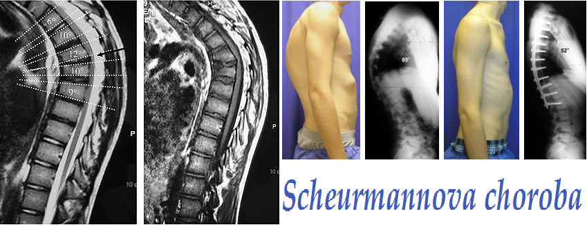 scheuermannova-choroba-nemoc-hyperkyfoza-priznaky-projevy-symptomy