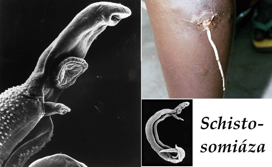 schistosomiaza priznaky projevy symptomy