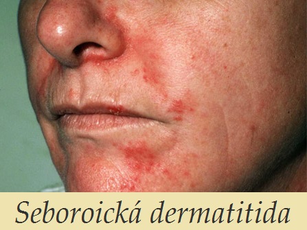 seboroicka dermatitida priznaky projevy symptomy