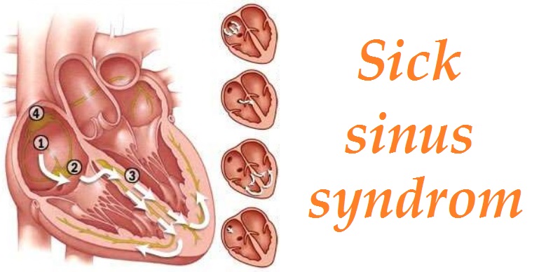 sick sinus syndrom sss priznaky projevy symptomy