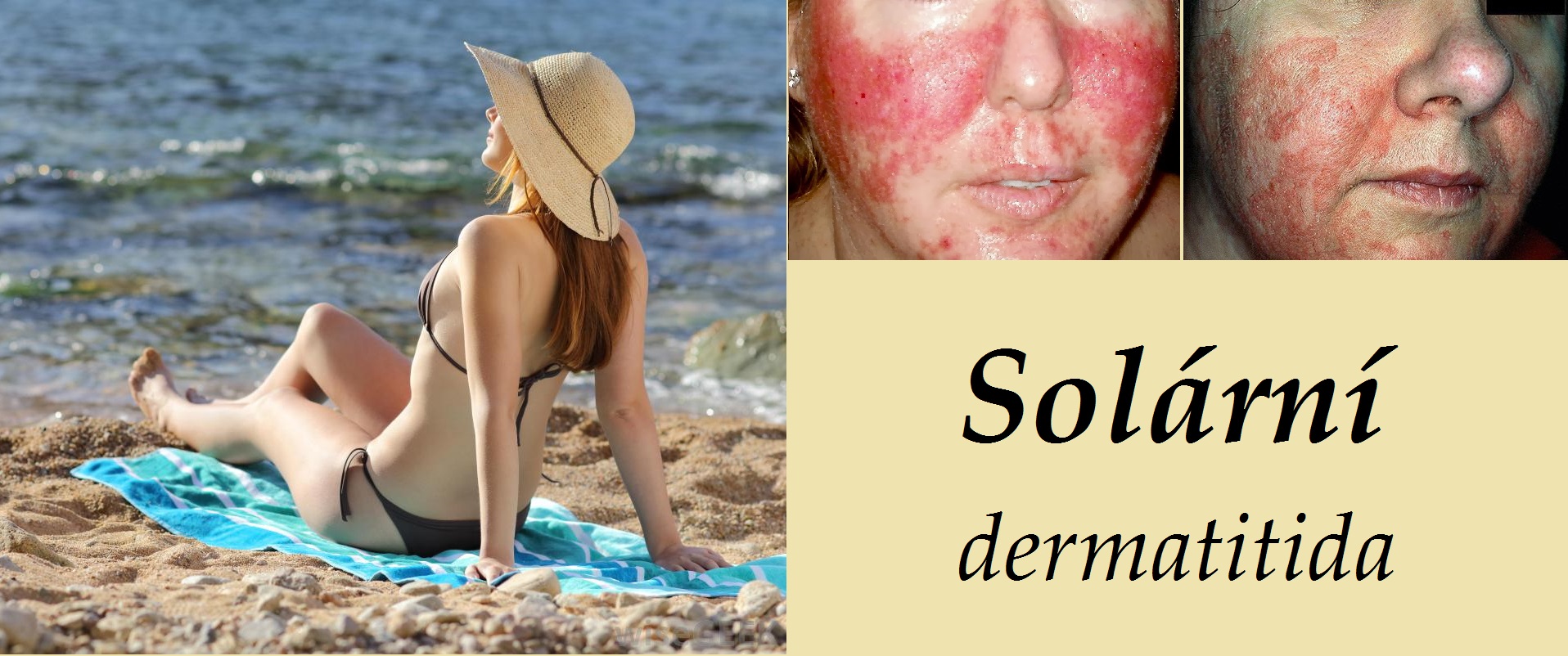 solarni dermatitida fotografie priznaky projevy symptomy pricina lecba obrazek