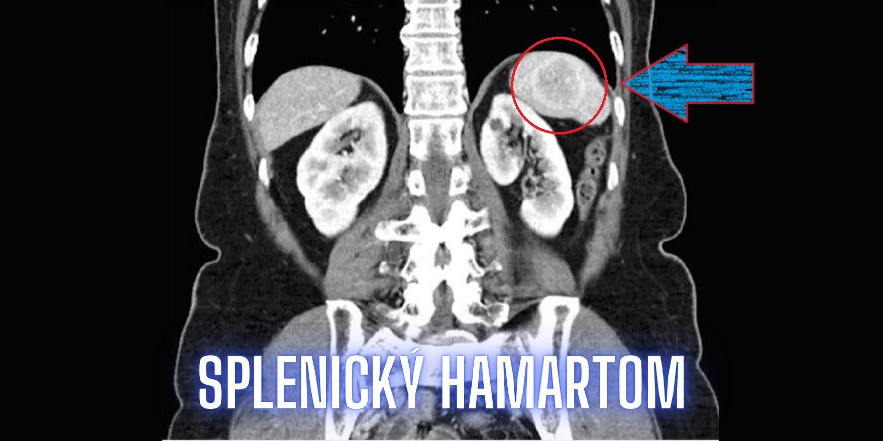 splenicky hamartom priznaky projevy symptomy diagnostika lecba