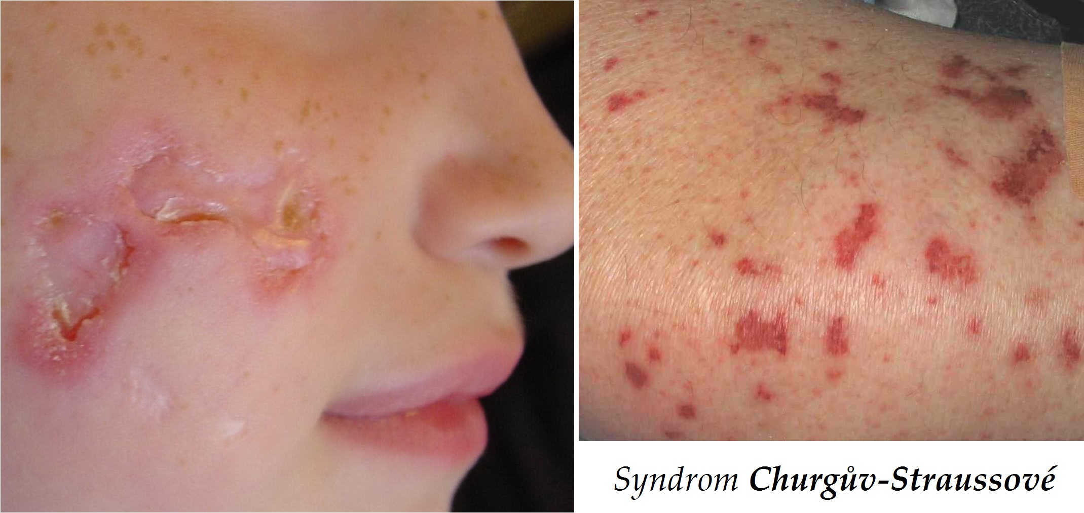 syndrom-churguv-straussove-alergicka-granulomatozni-angitida-priznaky-projevy-symptomy