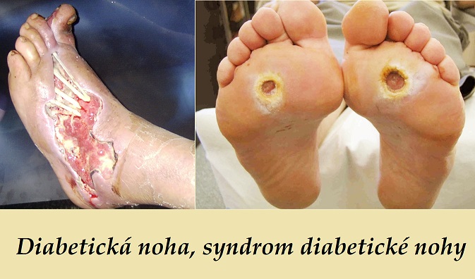 syndrom diabeticke nohy diabeticka noha priznaky projevy symptomy fotografie