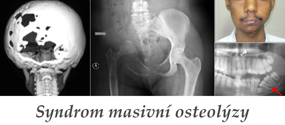 syndrom masivni osteolyzy priznaky projevy symptomy pricina lecba fotografie obrazek