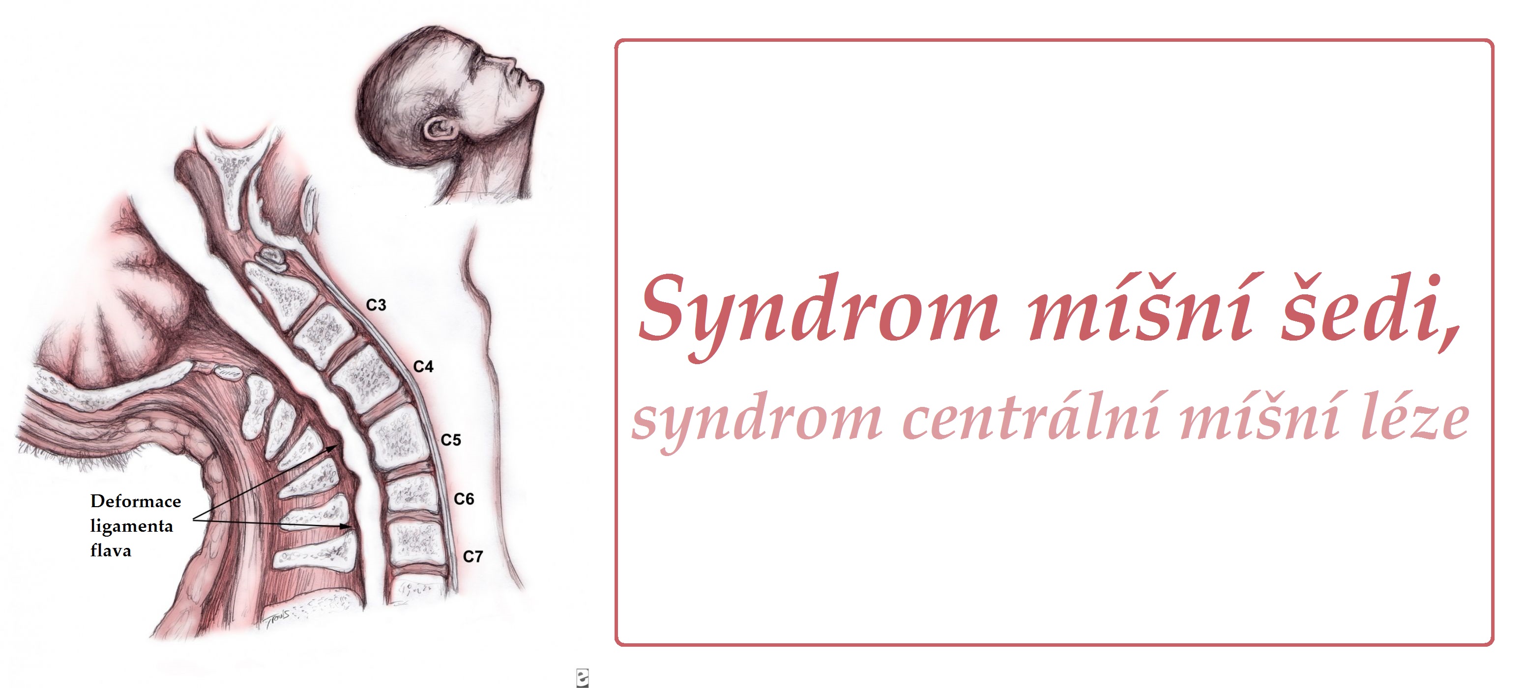 syndrom-misni-sedi-syndrom-centralni-misni-leze-central-cord-syndrome-ccs-priznaky-projevy